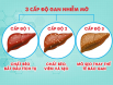 Gan nhiễm mỡ độ 1 gây nguy hiểm đến người bệnh như thế nào?